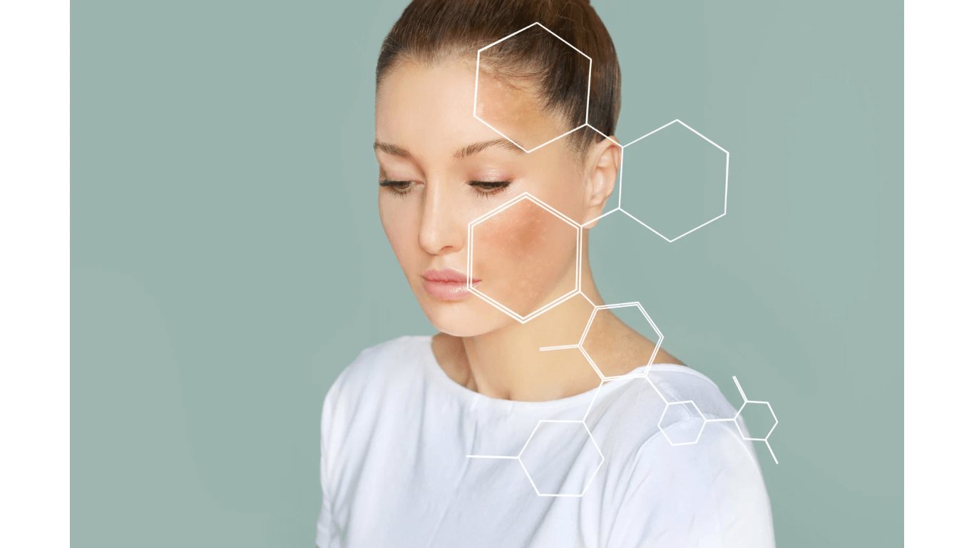 Pigmentation disorders
