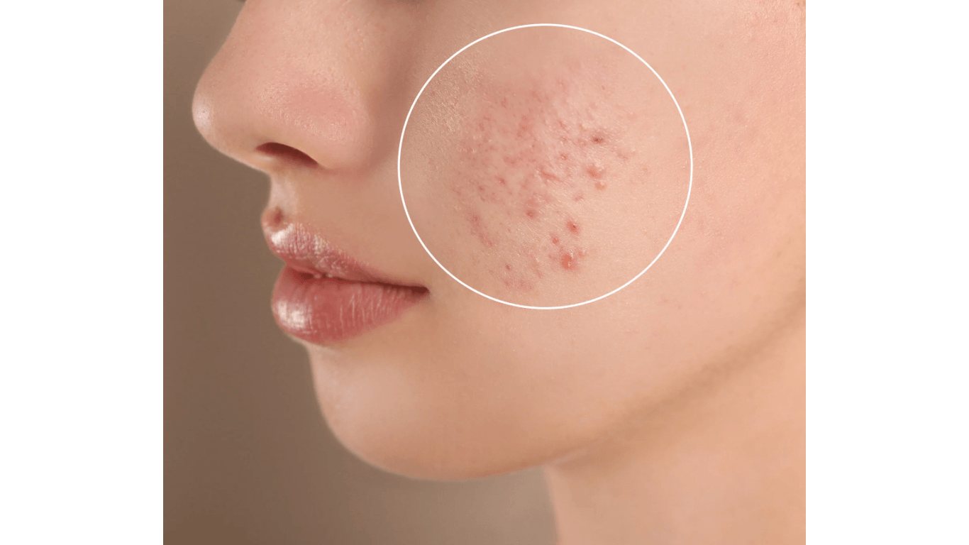 Teenage acne